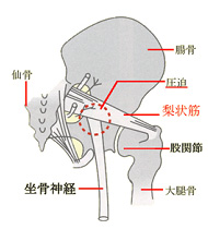 梨状筋症候群とは